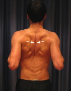 Exercises for Postural Syndrome - Shoulder Blade Squeezes