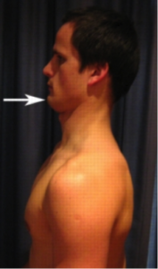 Exercises for Postural Syndrome - Chin Tucks